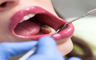 gum treatment, gum contouring