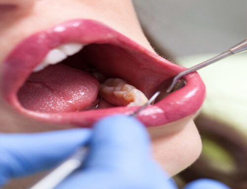 How Long Does Laser Gum Contouring Last?